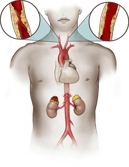 Anesthetic Management of Laparoscopic Adrenalectomy for a Patient with Concomitant Pheochromocytoma and Bilateral Carotid Artery Stenosis.