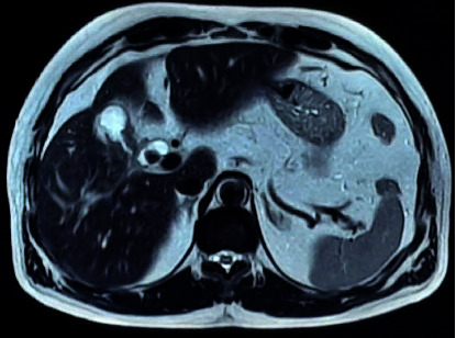 Xanthogranulomatous Cholecystitis Mimicking Carcinoma Gallbladder.