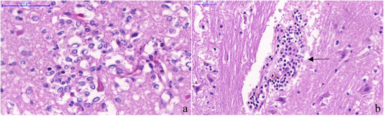 Neuropathology of yellow fever autopsy cases.