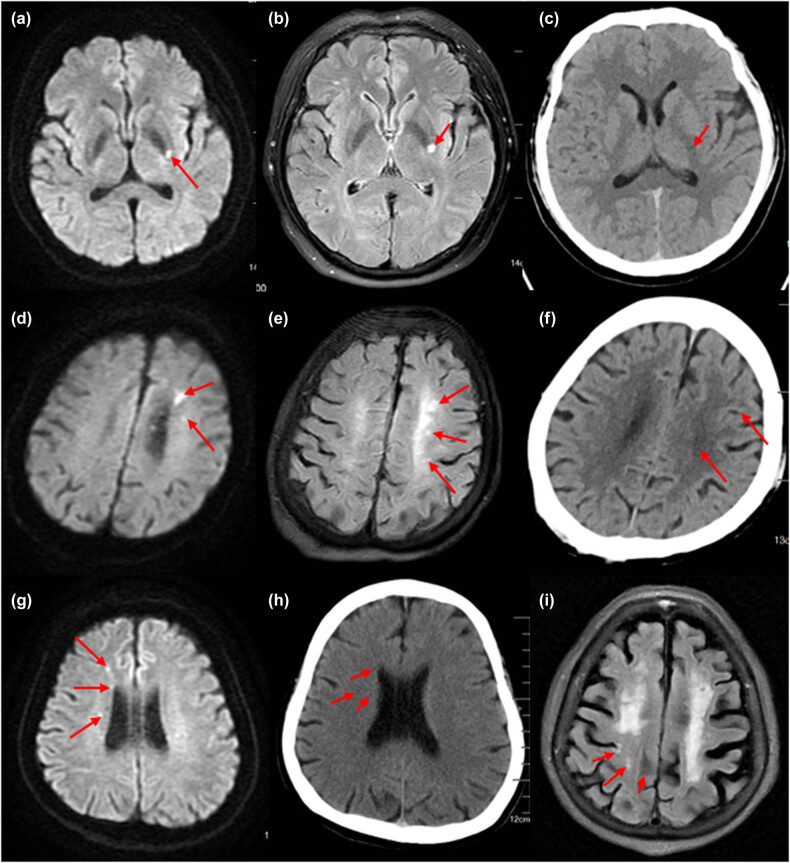 The clinical characteristics of acute cerebral infarction patients with thalassemia in a tropic area in China.