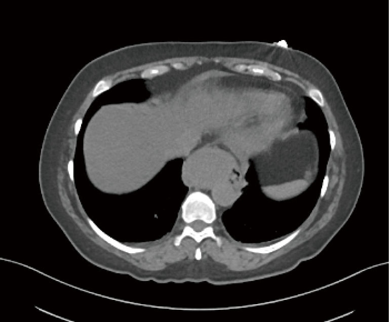 Esophageal duplication cysts: a clinical practice review.