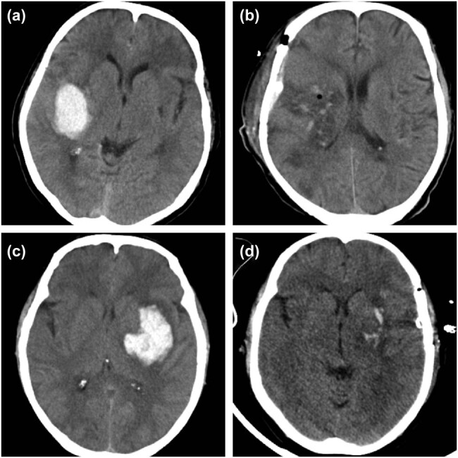 Hematoma evacuation based on active strategies versus conservative treatment in the management of moderate basal ganglia hemorrhage: A retrospective study.