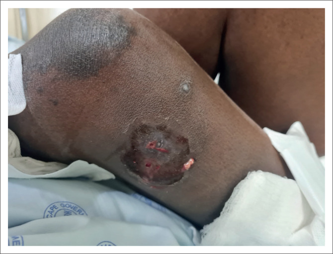 Cutaneous tuberculosis: An infrequent manifestation of a common pathogen in South Africa.