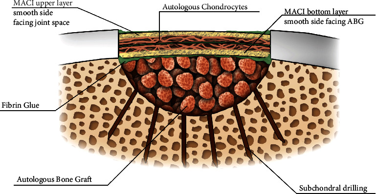 MACI "Sandwich" Technique for a Large Osteochondritis Dissecans Lesion: A Case Report.