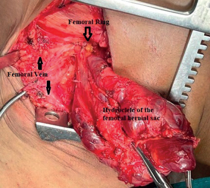 Bilateral Secondary Femorocele in a Case of Ascites Due to Cardiac Cirrhosis Following Dual Valvular Replacement for Rheumatic Heart Disease.