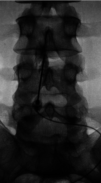 Epidural Blood Patch in a Patient with a Hematological Malignancy.