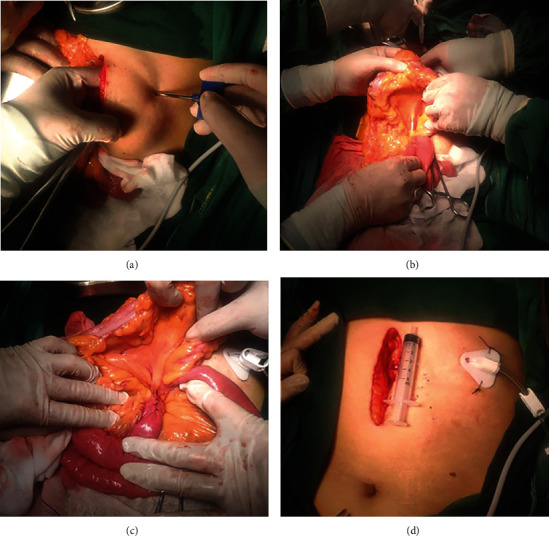 Ultra-Proximal Jejunostomy Application after McKeown-Type Esophagectomy: A Retrospective Case-Series Study.