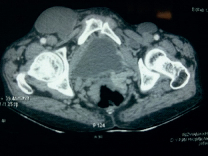 Bilateral Secondary Femorocele in a Case of Ascites Due to Cardiac Cirrhosis Following Dual Valvular Replacement for Rheumatic Heart Disease.