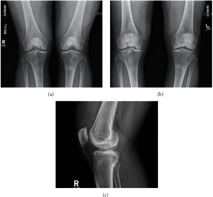 MACI "Sandwich" Technique for a Large Osteochondritis Dissecans Lesion: A Case Report.