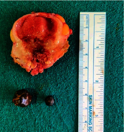 Xanthogranulomatous Cholecystitis Mimicking Carcinoma Gallbladder.