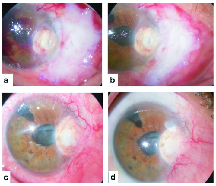 Retrocorneal Scleral Patch Supported Glue: A Technique for Management of Corneal Perforation and Corneoscleral Melt following Pterygium Surgery.