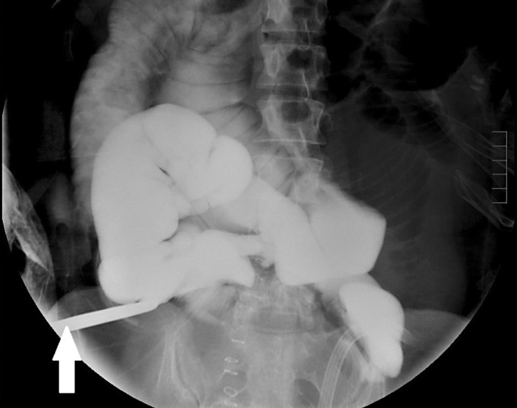 Early Onset Outlet Obstruction of a Temporary Diverting Loop Ileostomy Secondary to Urinary Retention.