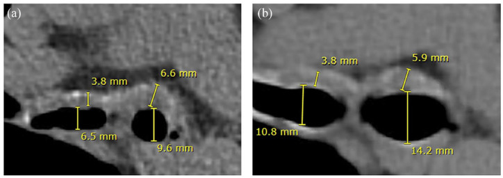 Determination of patient-specific airway stent fit using novel 3D reconstruction measurement techniques: a 4-year follow-up of a patient.