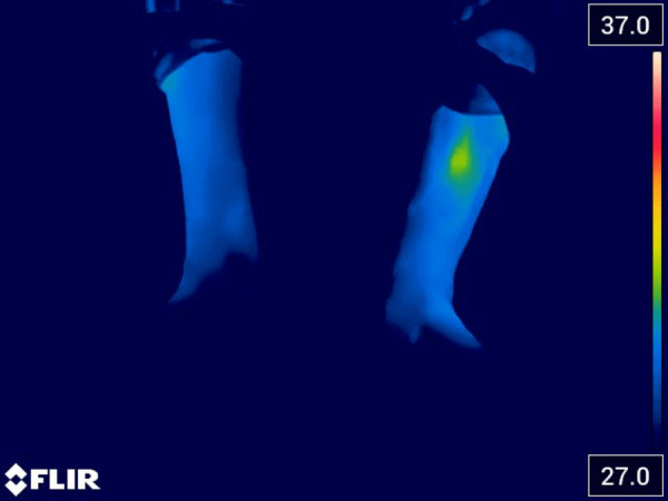 Effectiveness of REAC neuro postural and neuro psycho physical optimization in improving peripheral vasospasm dysfunction: a case report.