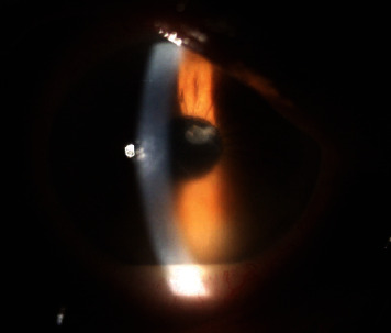 Citrobacter koseri: A Cause of Silicone Oil Related Endophthalmitis after Post Pars Plana Vitrectomy.