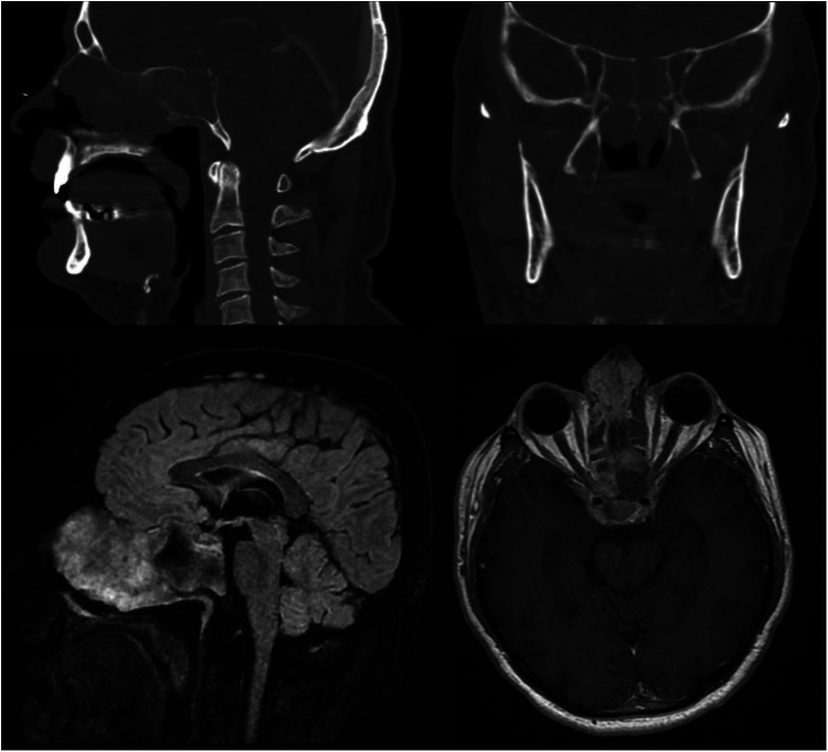 Loss of Vision Outcome for Allergic Fungal Sinusitis: Case Report and Literature Review.