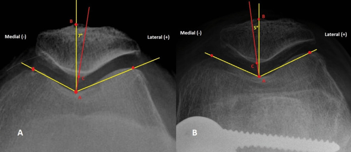 Radiographic measurement of the congruence angle according to Merchant: validity, reproducibility, and limits.