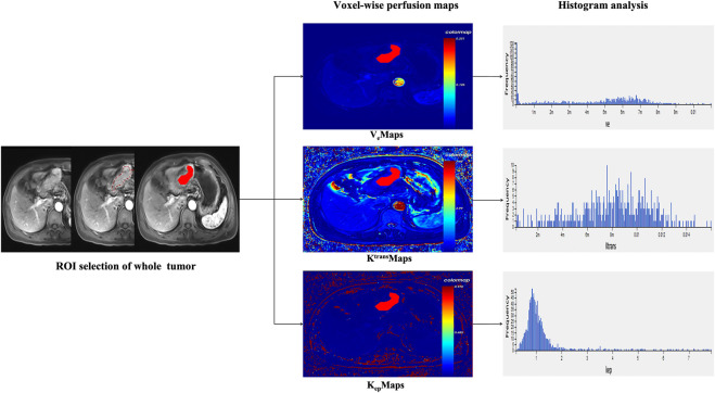 Association between radiomics features of DCE-MRI and CD8<sup>+</sup> and CD4<sup>+</sup> TILs in advanced gastric cancer.