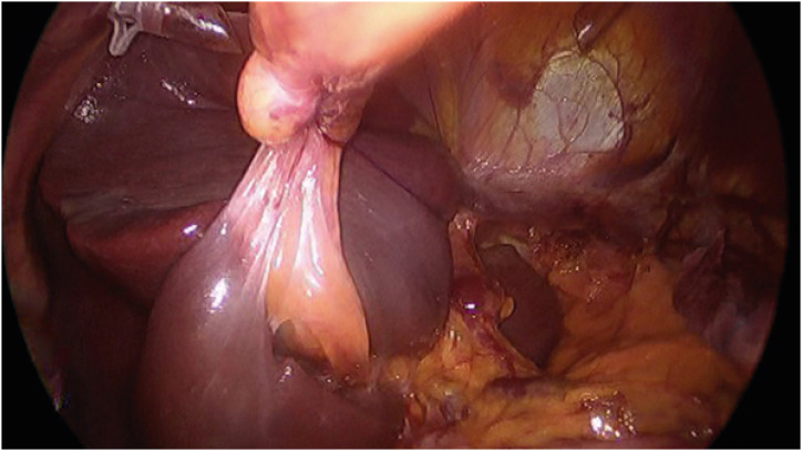 Mediastinal Lymph Node Dissection in Gastroesophageal Junction Adenocarcinoma.