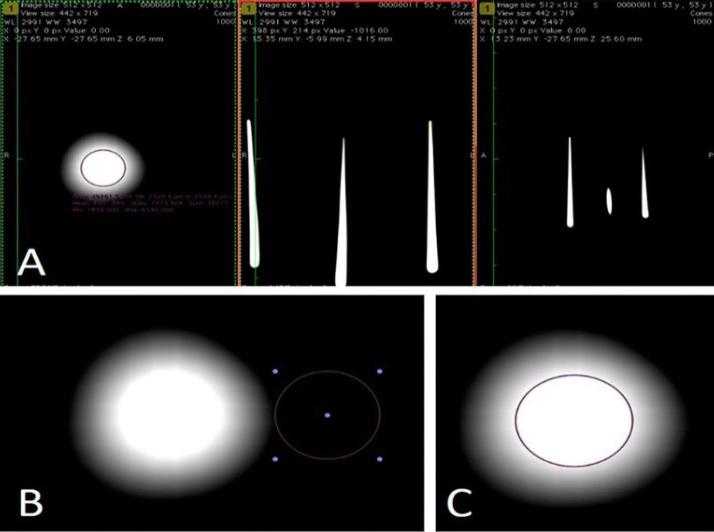 Influence of Apical Patency on the Adaptation of the Master Filling Cone: A Cone-beam Computed Tomography Assessment.