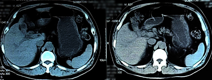 Xanthogranulomatous Cholecystitis Mimicking Carcinoma Gallbladder.