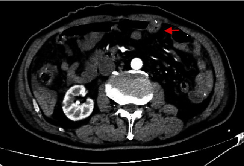 Ultra-Proximal Jejunostomy Application after McKeown-Type Esophagectomy: A Retrospective Case-Series Study.