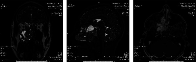 Case of IV Stage Juvenile Nasopharyngeal Angiofibroma Presurgically Treated with a Single ECA Stop-Flow Embolization Technique Using Onyx 18.