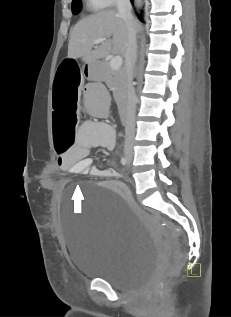 Early Onset Outlet Obstruction of a Temporary Diverting Loop Ileostomy Secondary to Urinary Retention.