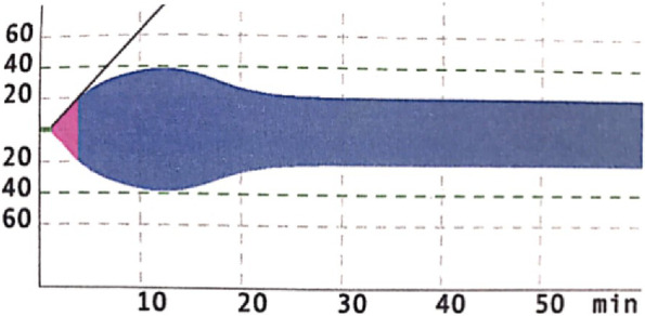 The use of rotational thromboelastometry parameters in understanding the coagulopathy following hump-nosed viper (Hypnale spp) bites: a preliminary study.