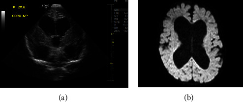 Novel TTN Mutation Causing Severe Congenital Myopathy and Uncertain Association with Infantile Hydrocephalus.