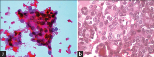 Cytological Features of "Non-Invasive Follicular Tumour with Papillary like Nuclear Features" - A Single Institutional Experience in India.