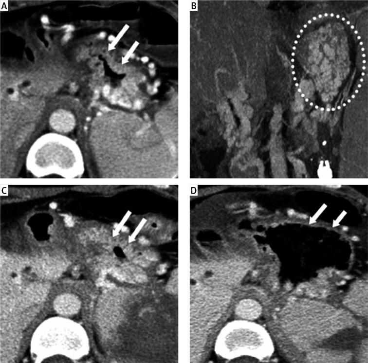 Splenic artery embolization for the treatment of pancreatic portal hypertension complicated by gastric variceal haemorrhage.