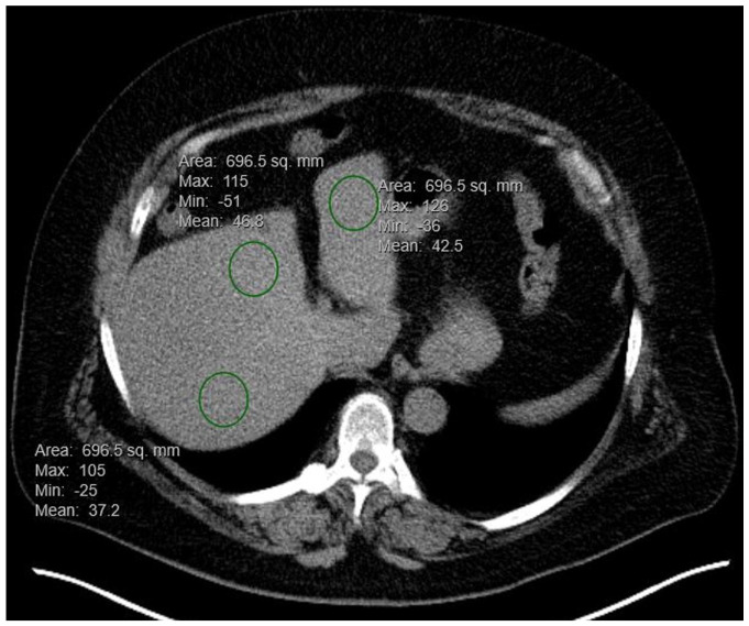 Frequency of Hepatic Metastatic Disease in Patients with Stage IV Breast Cancer Is Similar for Steatotic and Non-Steatotic Livers.