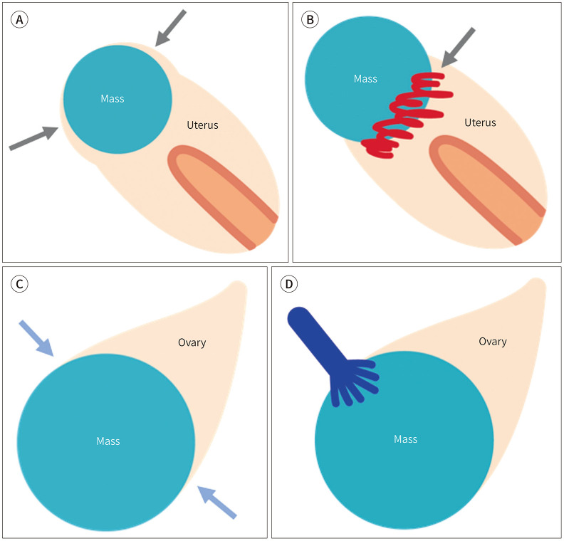 [Radiologic Evaluation of Uterine Lesions Using a Pattern Recognition Approach].