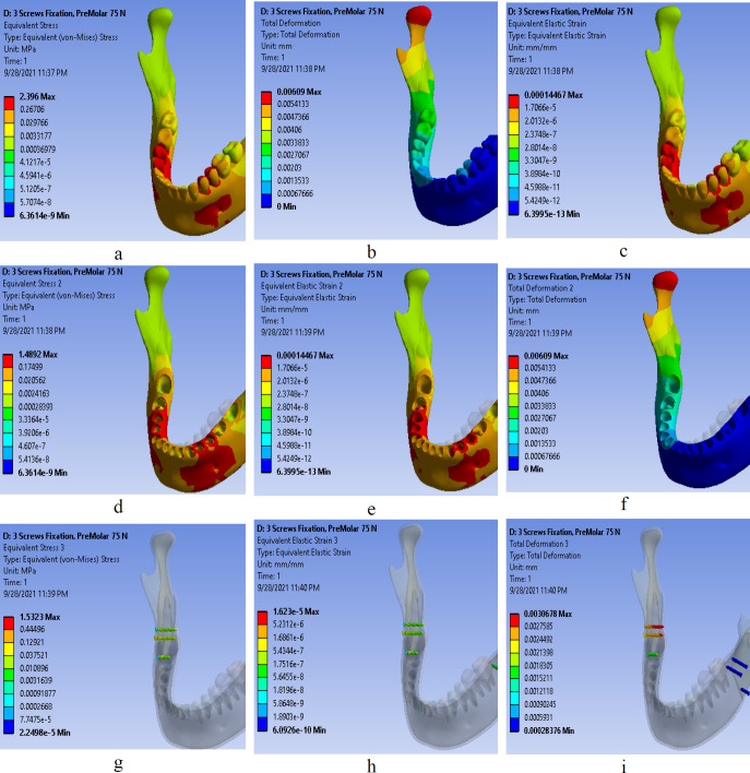 Three Different Fixation Modalities following Mandibular Setback Surgery with Sagittal Split Ramus Osteotomy: A Comparative Study using Three-dimensional Finite Elements Analysis.