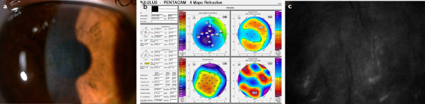 Central Toxic Keratopathy Following Corneal Collagen Cross-Linking.