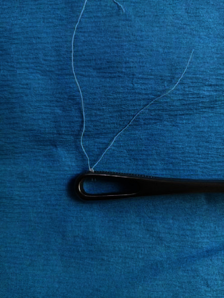 Novel Concepts for Intrauterine Device Placement at Caesarean Delivery: Description of Technique and Video Recording.