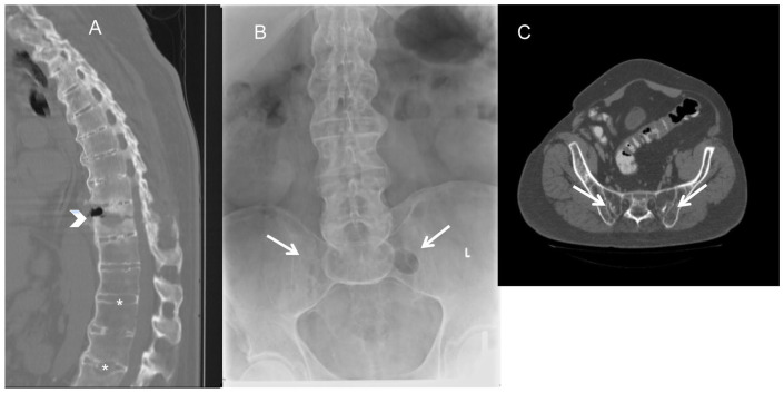 Spondyloarthropathies That Mimic Ankylosing Spondylitis: A Narrative Review.