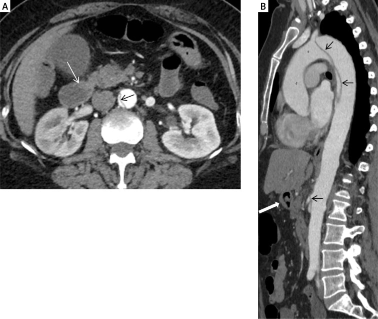 Type B aortic dissection atypically presenting as chronic abdominal pain.