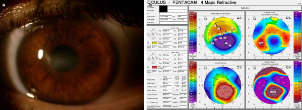 Central Toxic Keratopathy Following Corneal Collagen Cross-Linking.