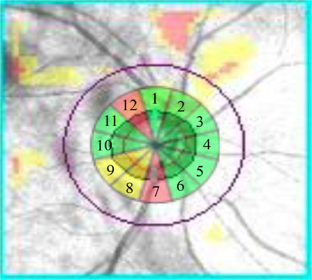 On the protective role of the blood vessels in glaucomatous damage: A transversal study