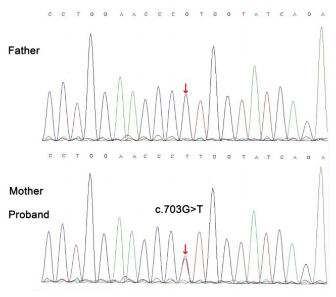 Bacterial Infections in a Child with TD-β-thalassemia and Common Variable Immunodeficiency Due to a Novel <i>NFKB1</i> Variant.