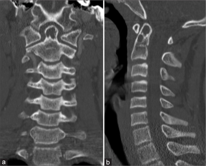 Single dose intralesional doxycycline foam infusion promotes bone growth and resolution of an odontoid aneurysmal bone cyst.