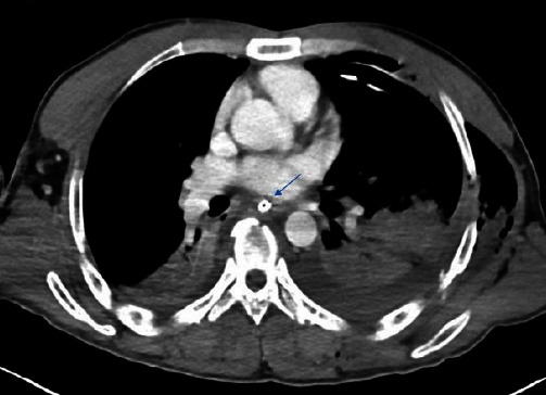 Occult Perforation of the Esophagus during Removal of an Enteral Feeding Tube: A Case Report and Literature Review.