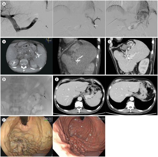 Isolated Gastric Varix Bleeding Caused by Splenic Vein Obstruction: Two Case Reports.