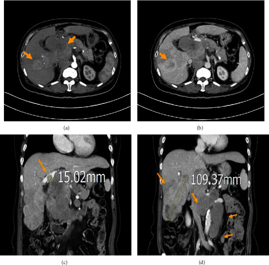 Lymphocyte-Rich Hepatocellular Carcinoma with Multiple Lymphadenopathy and Positive Epstein-Barr Virus Encoding Region.