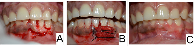 Intramucosal Melanocytic Nevi - A Rare Cause for Gingival Enlargement. Report of a Case and Review of Literature.