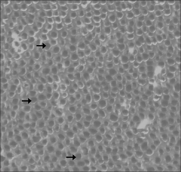 Evaluation of Dentin Remineralization with Zinc Oxide and Calcium Fluoride Nanoparticles - An <i>In vitro</i> Study.