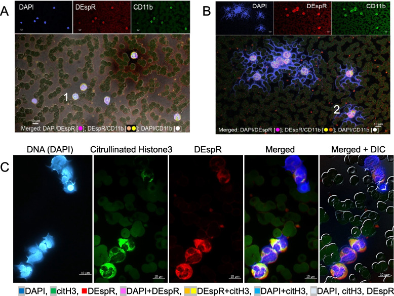 Circulating neutrophil extracellular trap (NET)-forming 'rogue' neutrophil subset, immunotype [DEspR + CD11b +], mediate multi-organ failure in COVID-19-<i>an observational study</i>.