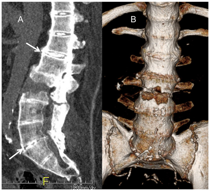 Spondyloarthropathies That Mimic Ankylosing Spondylitis: A Narrative Review.